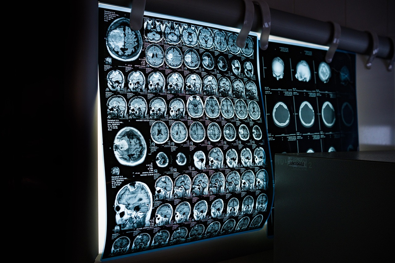 부작용 모니터링을 위한 뇌 MRI 판독 사진 4